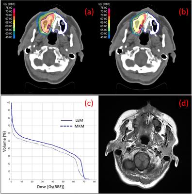 Dosimetric and Clinical Risk Factors for the Development of Maxillary Osteoradionecrosis in Adenoid Cystic Carcinoma (ACC) Patients Treated With Carbon Ion Radiotherapy